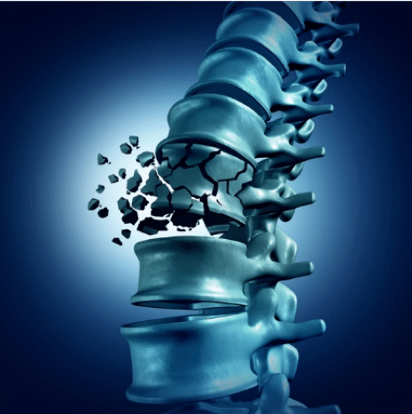 fracture de la moelle épinière